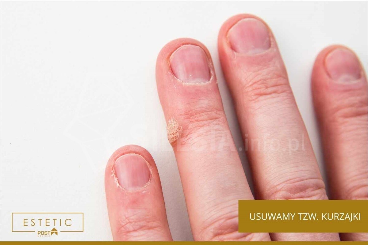 Usuwanie włókniaków i brodawek w Katowicach? Dojedziesz do nas w 20 minut.